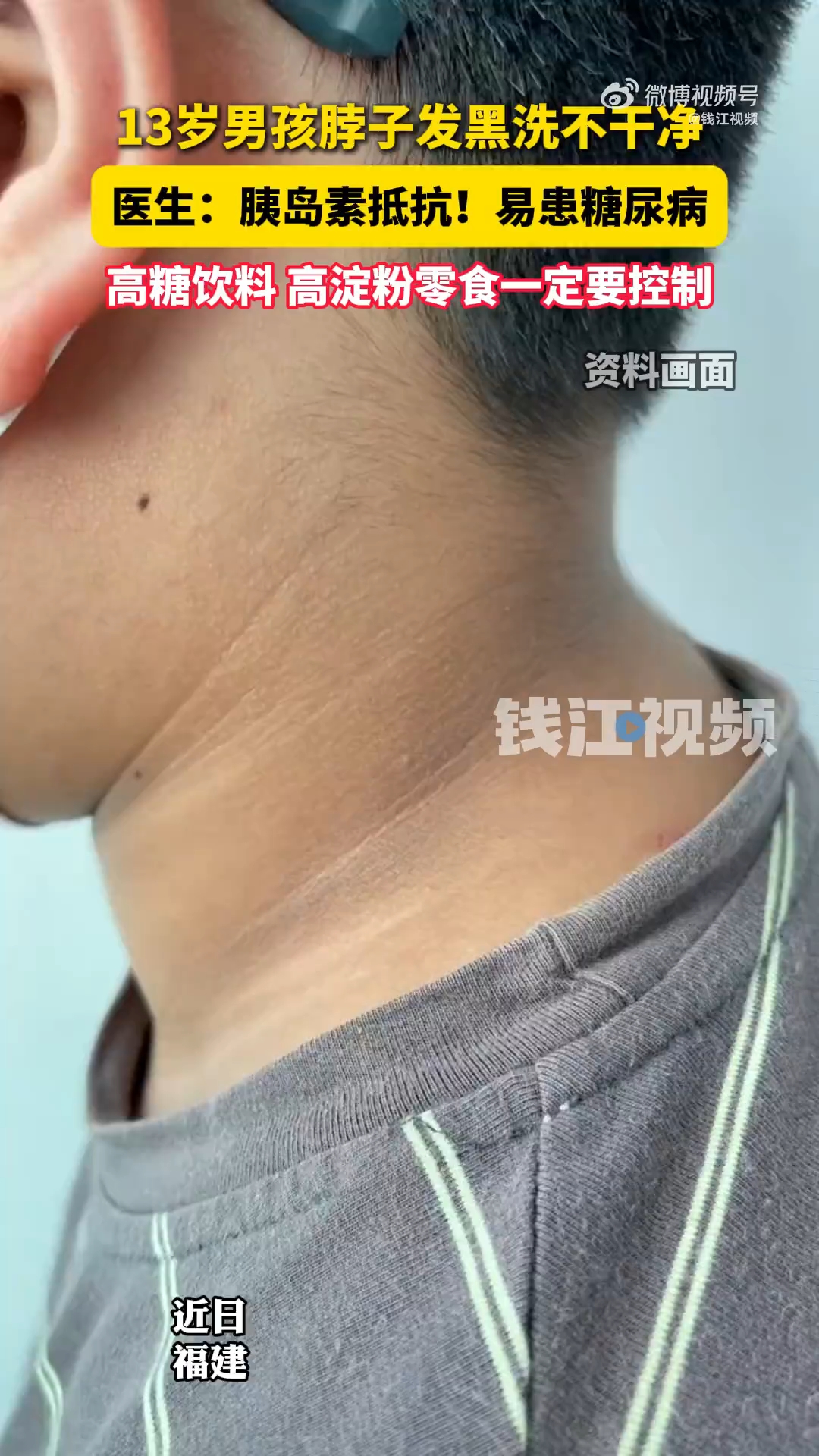 13岁男孩脖子洗不干净确诊黑棘皮病,医生提醒:是体内严重代谢紊乱的